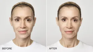 Woman before and after Restylane
