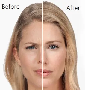 Botox before and after on a woman