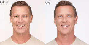 Botox before and after on a man