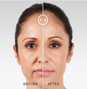 Woman before and after Juvederm