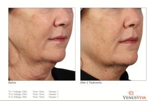 Venus Viva before and after - woman