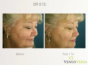 Woman before and after Venus Versa