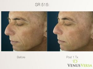 Man before and after Venus Versa
